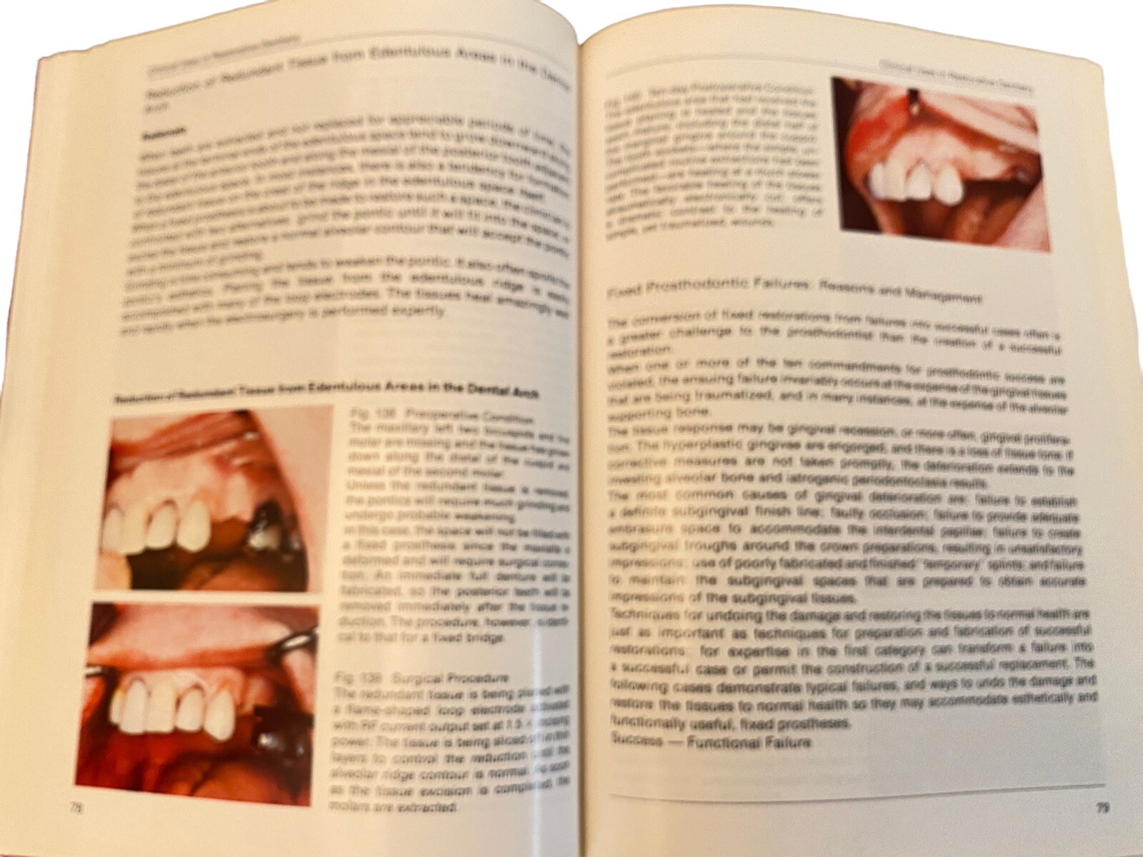 Color Atlas of Oral Electrosurgery Maurice J Oringer Hardback 250 Pages 1984