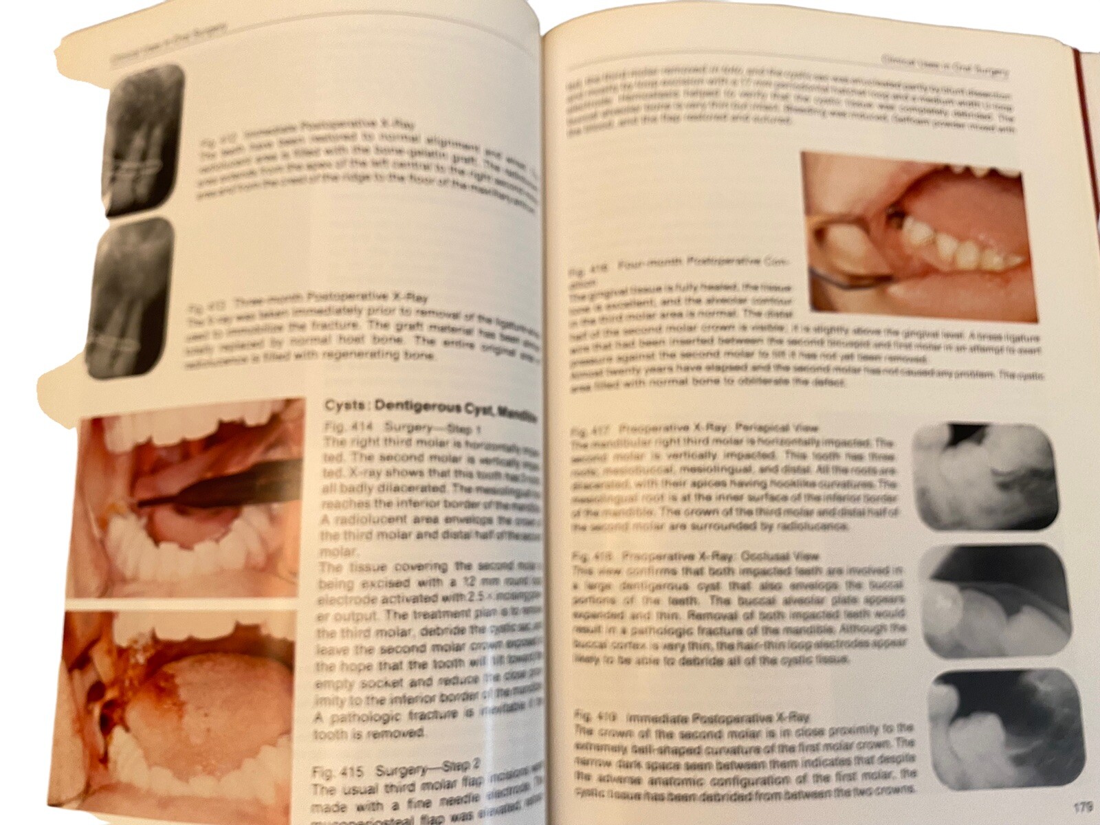 Color Atlas of Oral Electrosurgery Maurice J Oringer Hardback 250 Pages 1984