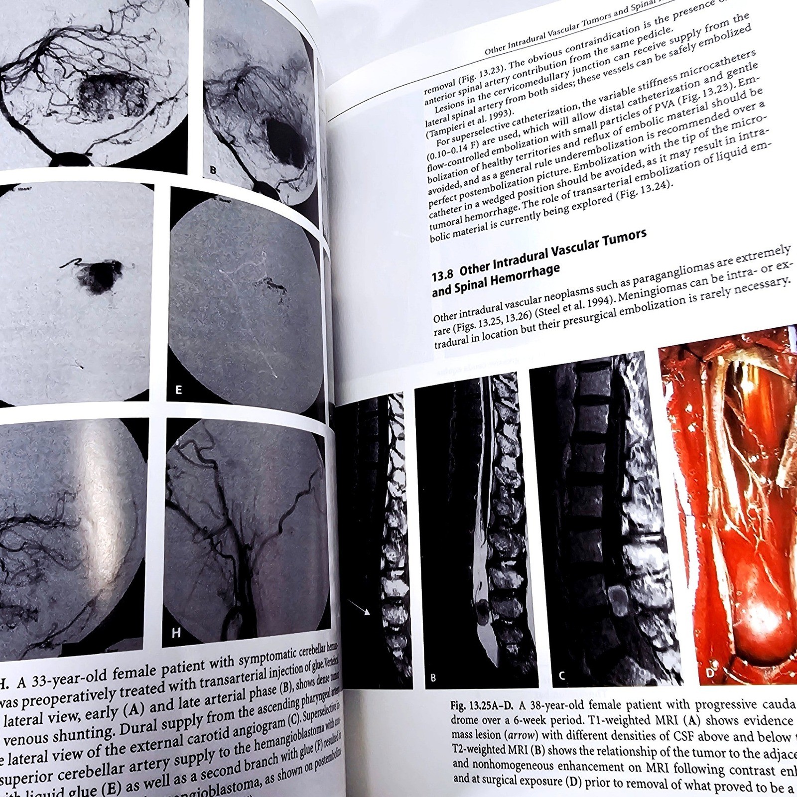 Springer Surgical Neuroangiography Berenstein Vol 2.1 2.2 Hardcover 2nd Ed 2004